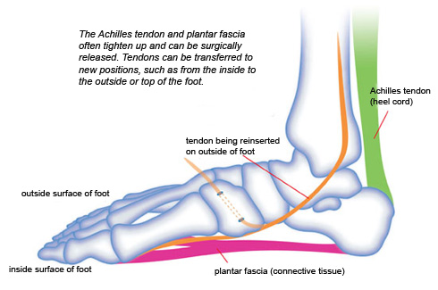 The Achilles tendon and plantar fascia often tighten up and can be surgically released. Tendons can be transferred to new positions, such as from the inside to the outside or top of the foot.