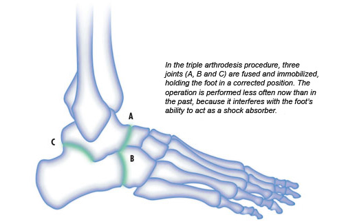 In the triple arthrodesis procedure, three joints (A, B and C) are fused and immobilized, holding the foot in a corrected position. The operation is performed less often now than in the past, because it interferes with the foot’s ability to act as a shock absorber.