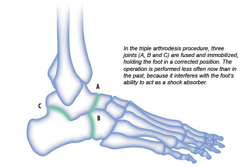 What is Over Supination; How to correct deformity of the foot.