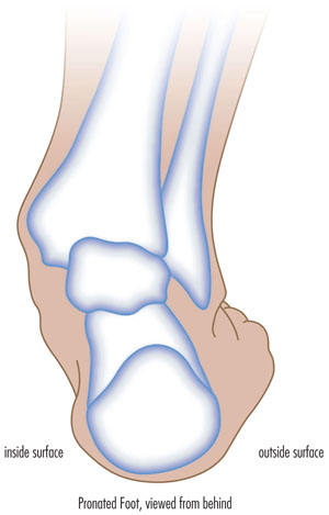What is Over Supination; How to correct deformity of the foot.