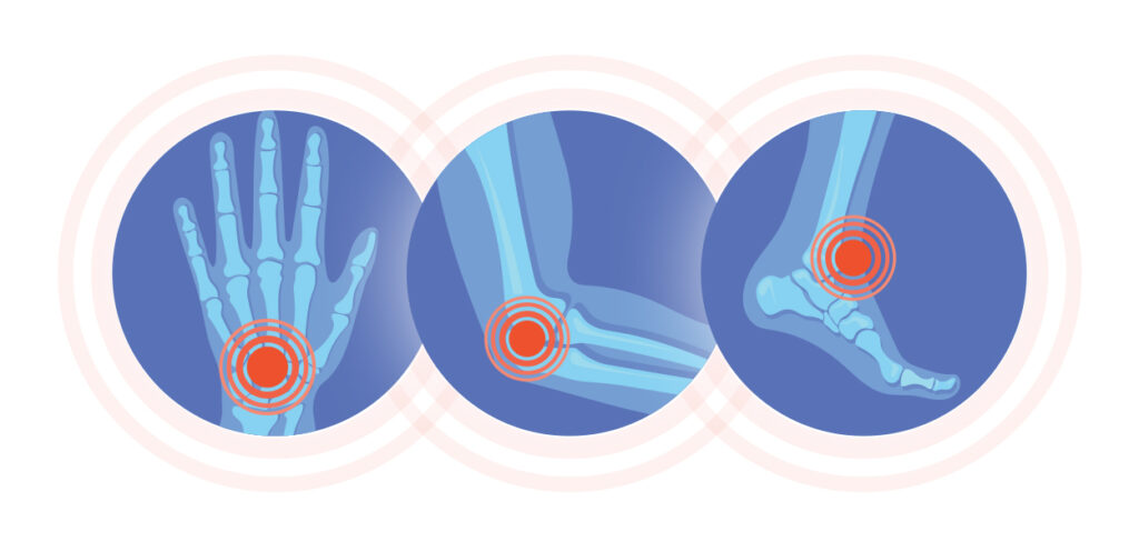 3 separate human skeletal clipart images are set in blue: a hand, with a red target indicating wrist contractures; a bent elbow, with a red target indicating elbow contractures; and a foot, with a red target indicating ankle contractures.