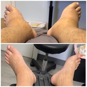 The top photo shows a pair of swollen ankles and feet. The bottom photo shows the same ankles and feet without swelling.