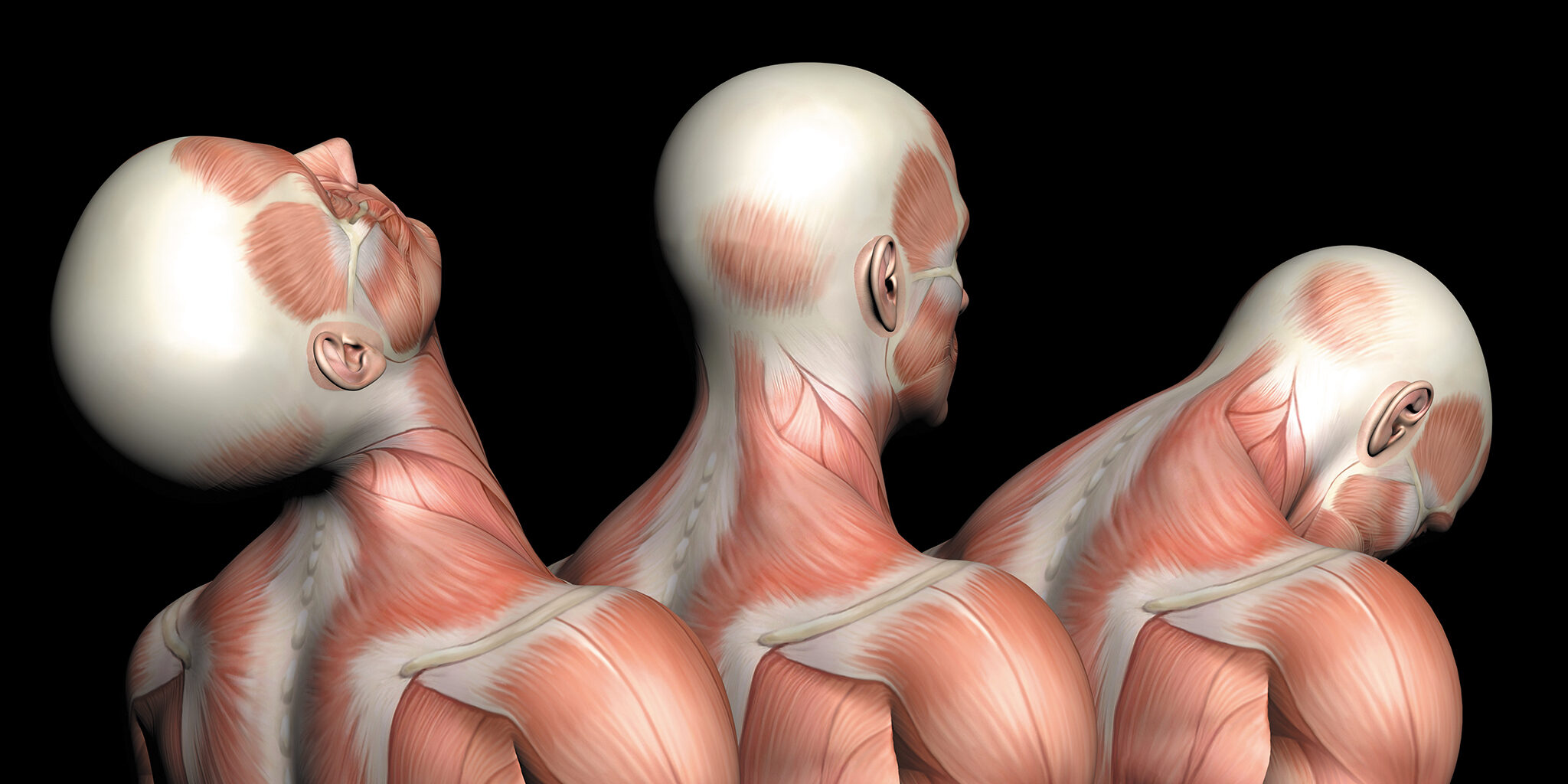 Medical illustration of musculature in the upper back, shoulders, neck, and head.