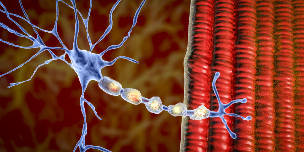 Demyelination of neuron, the damage of the neuron myelin sheath seen in demyelinating diseases, such as multiple sclerosis and other demyelinating myelinoclastic and leukodystrophic diseases, computer illustration.